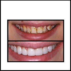 tooth whitening